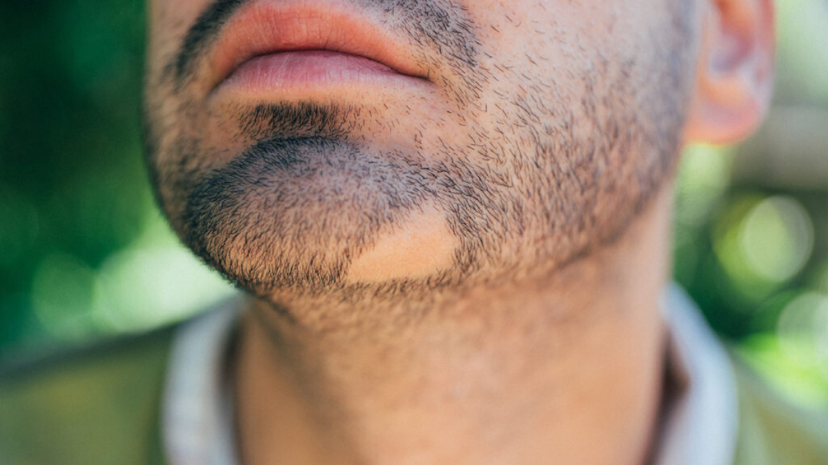 Les solutions pour ne plus avoir de trou dans la barbe 